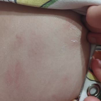 Peros Tablet Deterjanı Nedeniyle Şiddetli Alerjik Reaksiyon Ve İade Talebi
