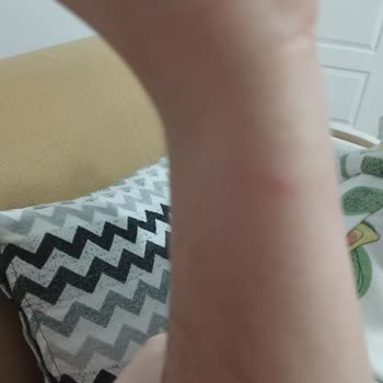 Peros Tablet Deterjanı Nedeniyle Şiddetli Alerjik Reaksiyon Ve İade Talebi