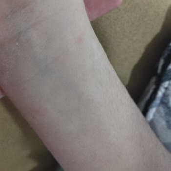 Peros Tablet Deterjanı Nedeniyle Şiddetli Alerjik Reaksiyon Ve İade Talebi