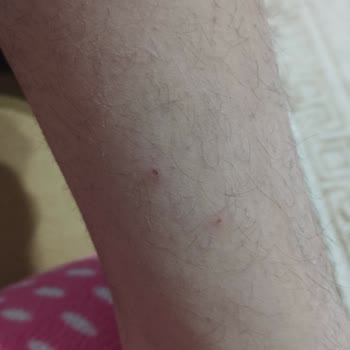 Peros Tablet Deterjanı Nedeniyle Şiddetli Alerjik Reaksiyon Ve İade Talebi