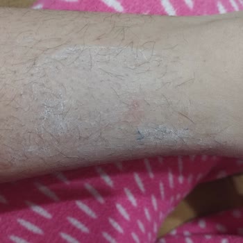 Peros Tablet Deterjanı Nedeniyle Şiddetli Alerjik Reaksiyon Ve İade Talebi