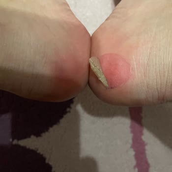 Kalitesiz Bot Ayak Yarası Verdi, Rahatsızlık Yaratıyor Ve Ücret İadesi İstiyorum