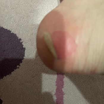 Kalitesiz Bot Ayak Yarası Verdi, Rahatsızlık Yaratıyor Ve Ücret İadesi İstiyorum