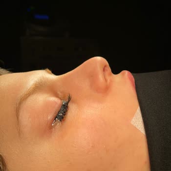 İki Burun Ameliyatı Ve 60 Bin TL’ye Karşı Beklenen Estetik Ve Nefes Çözümü Sağlanamadı