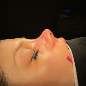 İki Burun Ameliyatı Ve 60 Bin TL’ye Karşı Beklenen Estetik Ve Nefes Çözümü Sağlanamadı