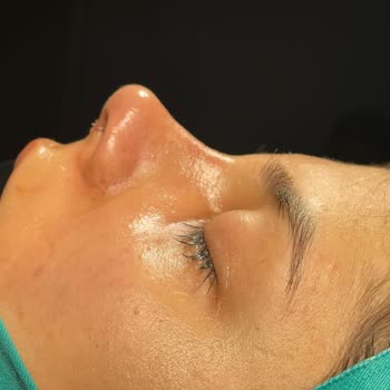 İki Burun Ameliyatı Ve 60 Bin TL’ye Karşı Beklenen Estetik Ve Nefes Çözümü Sağlanamadı