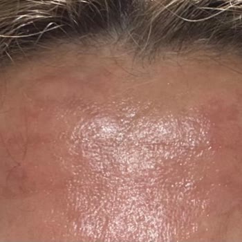 Kiehl's Gece Serumu Yanma Ve Yanık Oluşturdu, Müşteri Hizmetleri Cevapsız