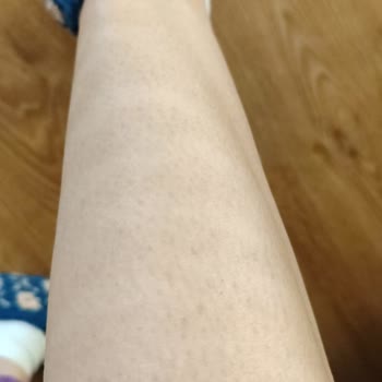 Kalıcı Pigment Farkları Ve Hizmet Aksaması Nedeniyle İade Talebi