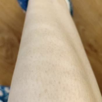 Kalıcı Pigment Farkları Ve Hizmet Aksaması Nedeniyle İade Talebi