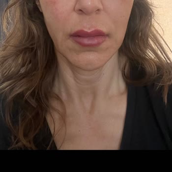 İstenen Düzeltme Sağlanmadı Ve Yüz Genişledi, Ücret İadesi Talebi