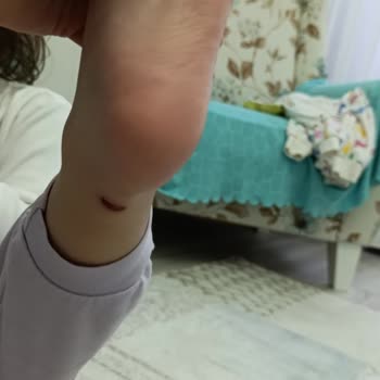 Vicco Çocuk Ayakkabısı Ayağını Yaktı Ve Mağaza Çözüm Sunmadı