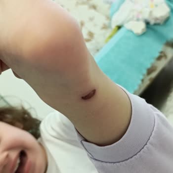 Vicco Çocuk Ayakkabısı Ayağını Yaktı Ve Mağaza Çözüm Sunmadı