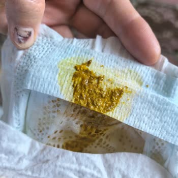 Prima Premium Care 2 Numaralı Bezlerde Sızdırma Ve Ücret İadesi Talebi