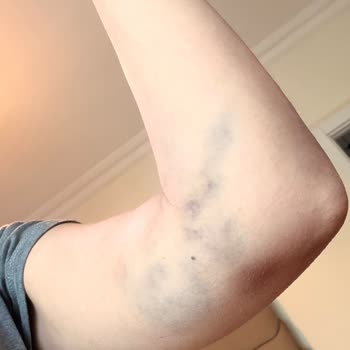 Kolan Hastanesi Kan Verme İşleminde Hatalı Uygulama Ve Şiddetli Ağrı Şikayeti