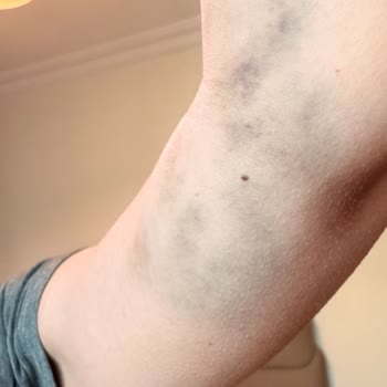 Kolan Hastanesi Kan Verme İşleminde Hatalı Uygulama Ve Şiddetli Ağrı Şikayeti