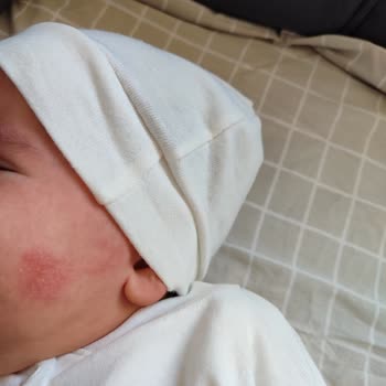 Bebeğimde Şiddetli Kızarıklık Yaratan Mustela Kremi İçin İade Talebi