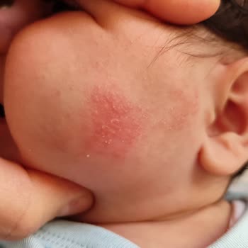 Bebeğimde Şiddetli Kızarıklık Yaratan Mustela Kremi İçin İade Talebi