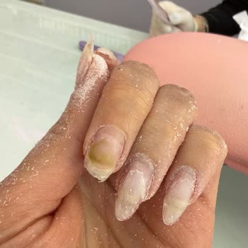 Hijyen Eksikliği Nedeniyle Protez Tırnakta Sağlık Problemi