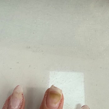 Hijyen Eksikliği Nedeniyle Protez Tırnakta Sağlık Problemi