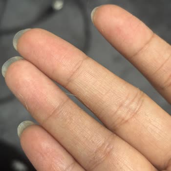 Yves Rocher BB Kremi Üretim Hatası Ve Ciltte Pul Pul Dökülme