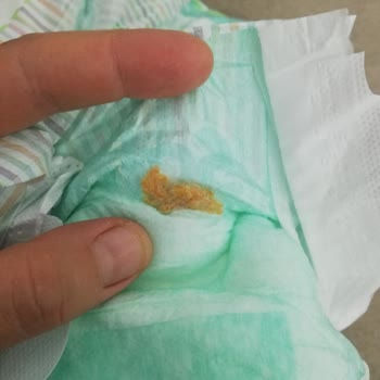 Adana'daki A101 Mağazasındaki Soffia Çocuk Bezinde Yabancı Cisim Bulundu