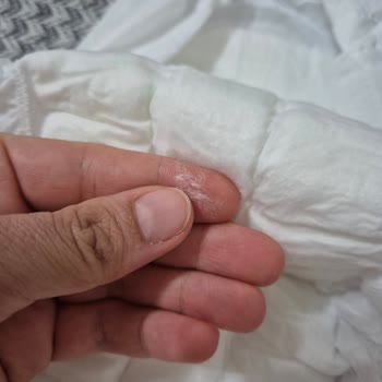 Sleepy Bezlerde Pamukçuk Birikimi Ve Sağlık Riski