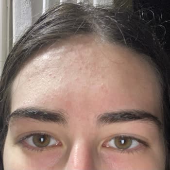 Morfose Kremsi Süt Şampuanı Alerjik Reaksiyon Ve İade Sorunu