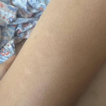 Kalıcı Yanık Ve Lekeler Bırakan IPL Cihazı İçin Ürün İncelemesi Talebi