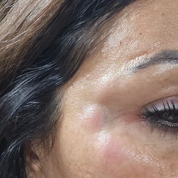 Sahte Botox Ve Doktor Olmayan Kişi Tarafından Yüz İşlemi: Sağlık Riski Ve Ücret İadesi Talebi