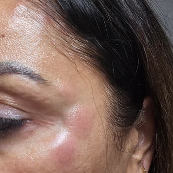 Sahte Botox Ve Doktor Olmayan Kişi Tarafından Yüz İşlemi: Sağlık Riski Ve Ücret İadesi Talebi
