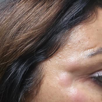 Sahte Botox Ve Doktor Olmayan Kişi Tarafından Yüz İşlemi: Sağlık Riski Ve Ücret İadesi Talebi