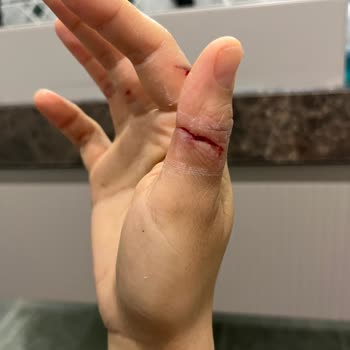 Cam Kettle Kapağının Aniden Kırılması Ve Ciddi Kesik
