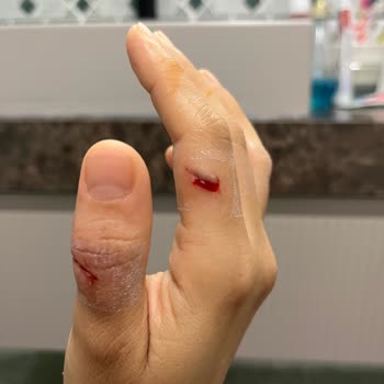 Cam Kettle Kapağının Aniden Kırılması Ve Ciddi Kesik