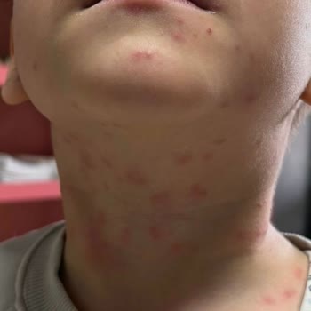 Şamlar Tabiat Parkı'nda Zehirli Tırtıllar Alerjik Reaksiyonlara Neden Oluyor