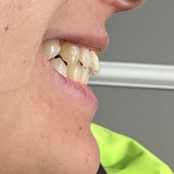 Ortodonti Tedavisinde Hatalı Planlama Ve Aşırı Ücret Talebi