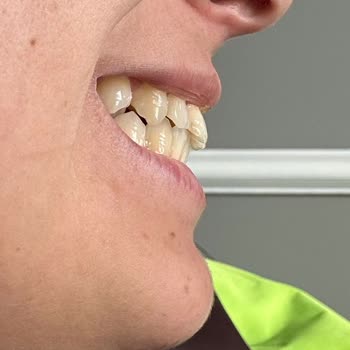 Ortodonti Tedavisinde Hatalı Planlama Ve Aşırı Ücret Talebi