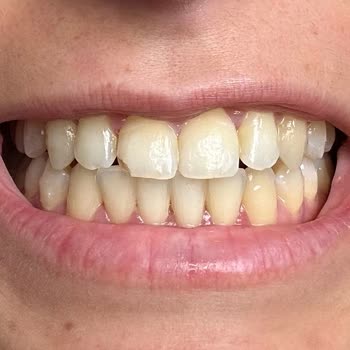 Ortodonti Tedavisinde Hatalı Planlama Ve Aşırı Ücret Talebi