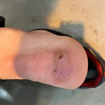 Yanıltıcı Satış Açıklamaları Nedeniyle Ayağımda Şiddetli Yaralar