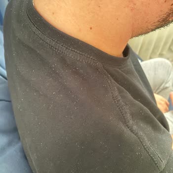 Daily Perfection Şampuanında Şiddetli Kepek Ve Kaşıntı