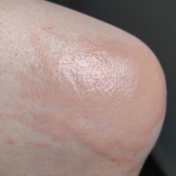 Melikgazi Hastanesi Muayenesiz Ve Tahlilsiz 11.500 TL’lik Tedavide Hastaya Aşırı İhmal