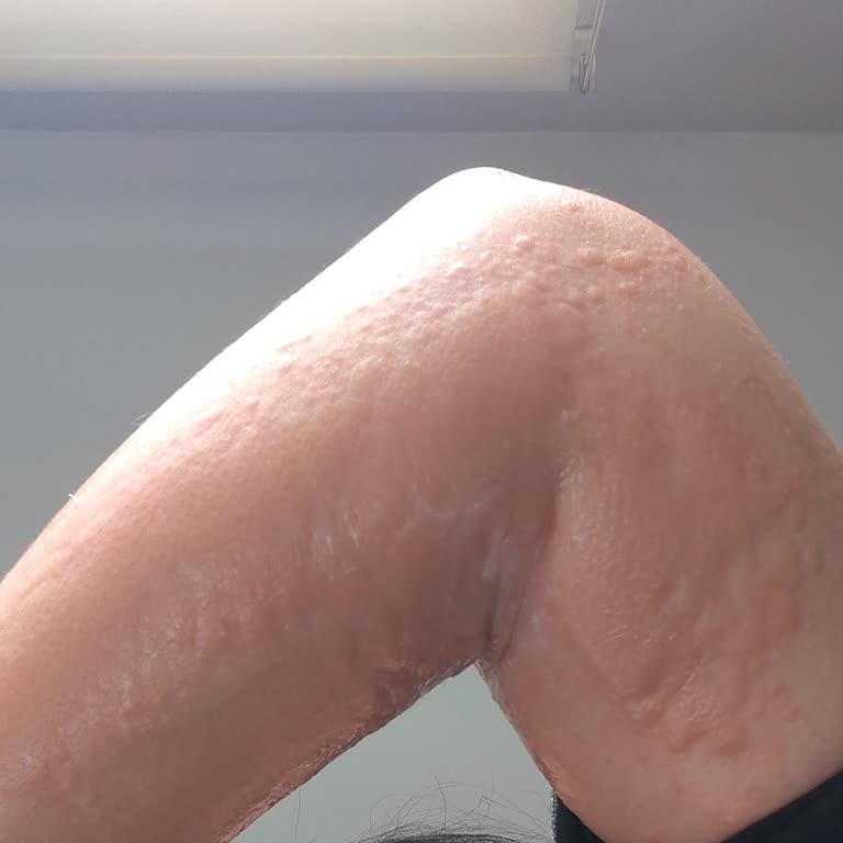 Melikgazi Hastanesi Muayenesiz Ve Tahlilsiz 11.500 TL’lik Tedavide Hastaya Aşırı İhmal