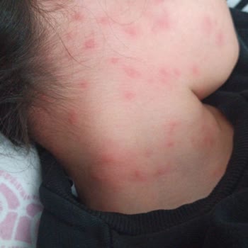 Şamlar Tabiat Parkı’nda Çam Kese Böceği Nedeniyle Alerjik Mağduriyet Ve Uyarı Eksikliği