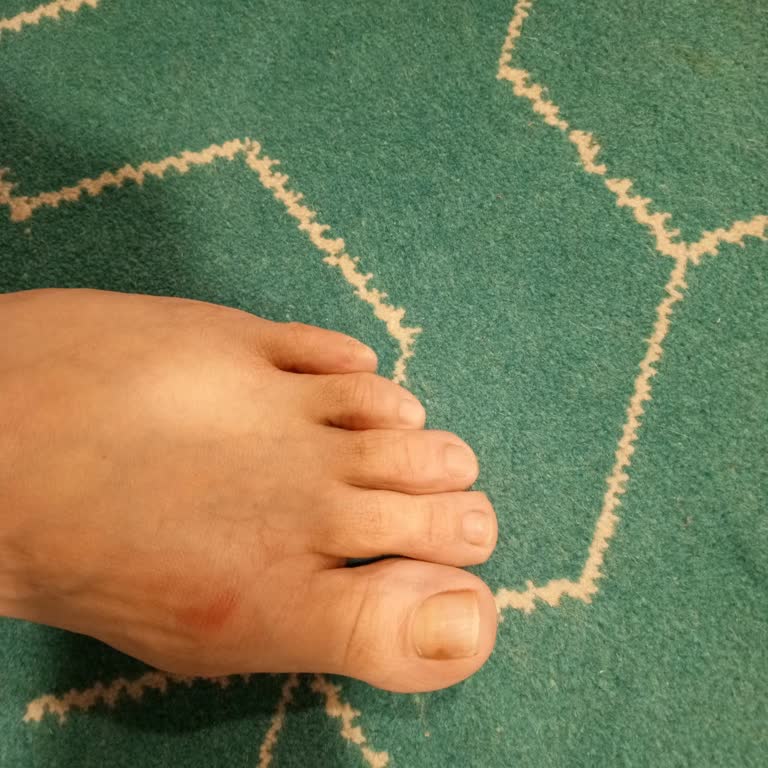 Skechers Ayakkabısındaki Üretim Hatası Yaran Çıkıntı Nedeniyle İade Talebi