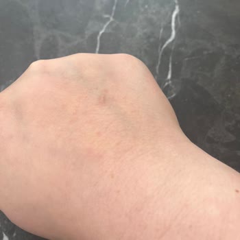 İkinci Dozda Ciltte Şiddetli Reaksiyon Ve Firma Tarafından Cevapsızlık