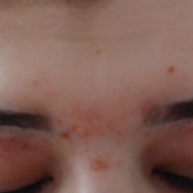 Ten Tüy Dökücü Aloe Vera Ürünü Göz Çevresinde Şiddetli Yanma Ve Şişlik Yarattı