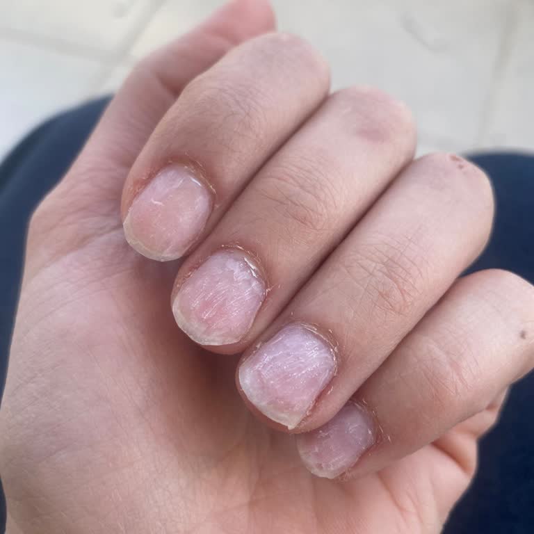 Babydoll Nail Art’ta Tırnak Çıkarma Sonrası Tırtıklı Tırnaklar Ve Kaba Çalışan Tavırları