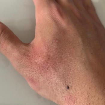 İstikbal Baza Ve Başlığında Tahtakurusu Sorunu