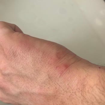 İstikbal Baza Ve Başlığında Tahtakurusu Sorunu