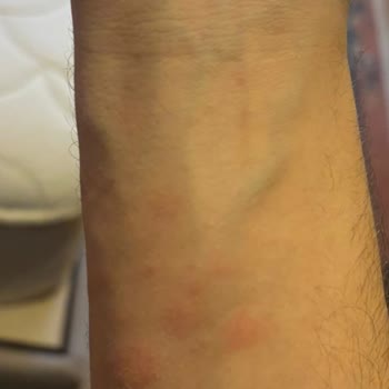 İstikbal Baza Ve Başlığında Tahtakurusu Sorunu