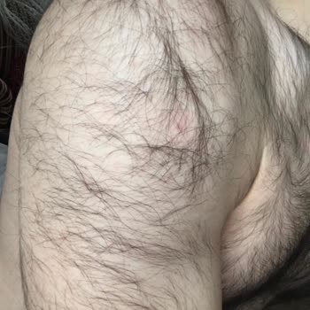 Glory Güzellik Merkezinde Lazer Epilasyonda Bitiş Garantisi İhlali Ve Yanık Olayı